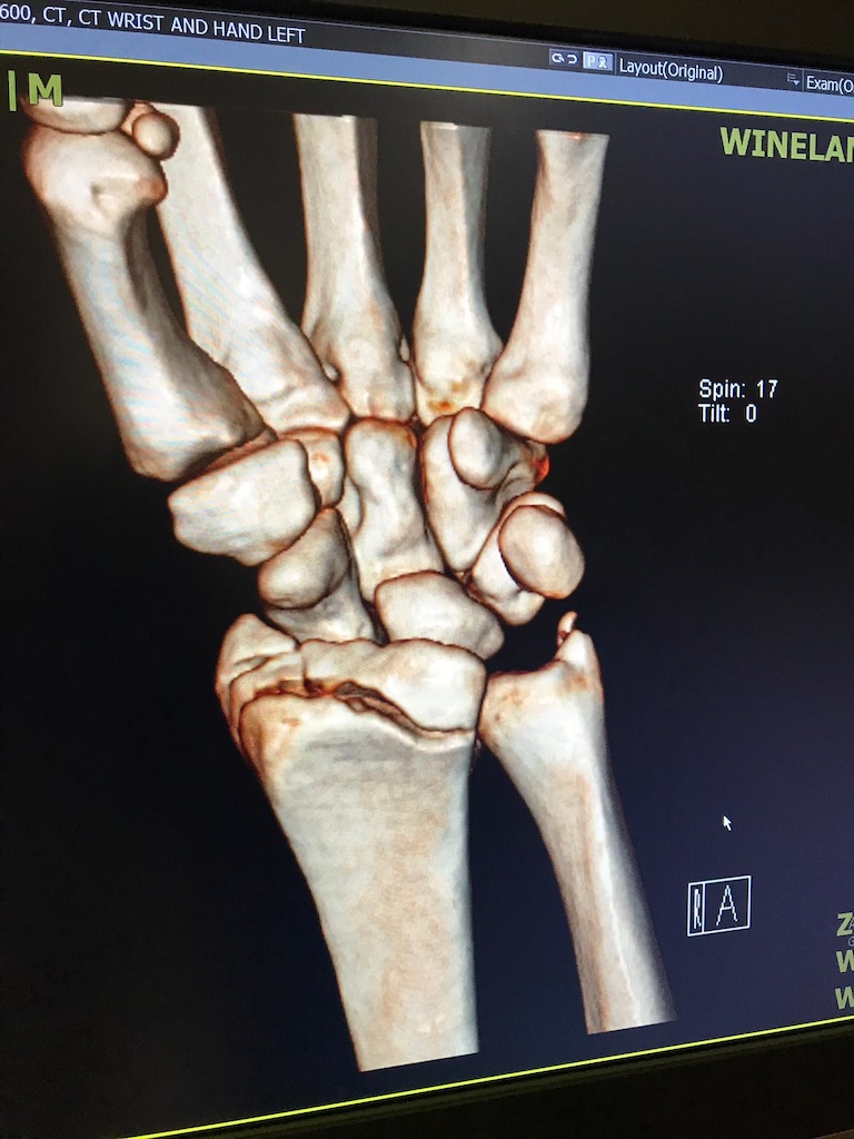Sam's broken hand