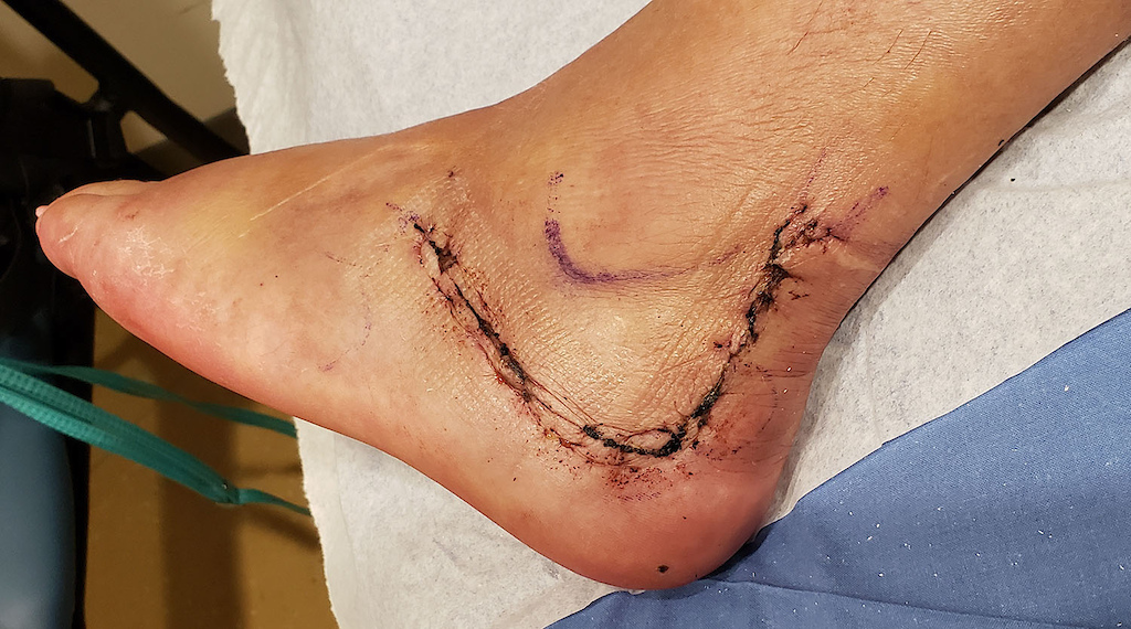 Broken heel bone with plate