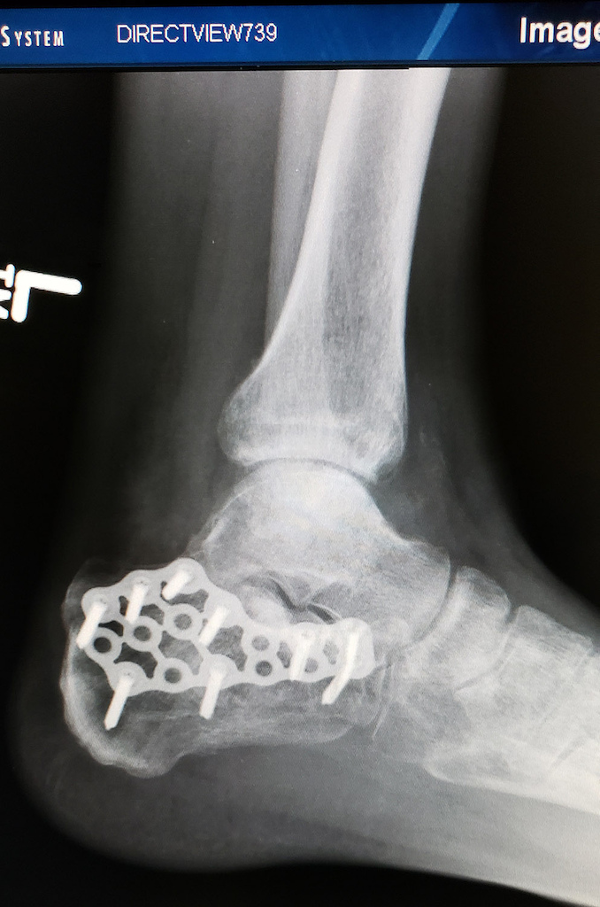 Broken heel bone with plate