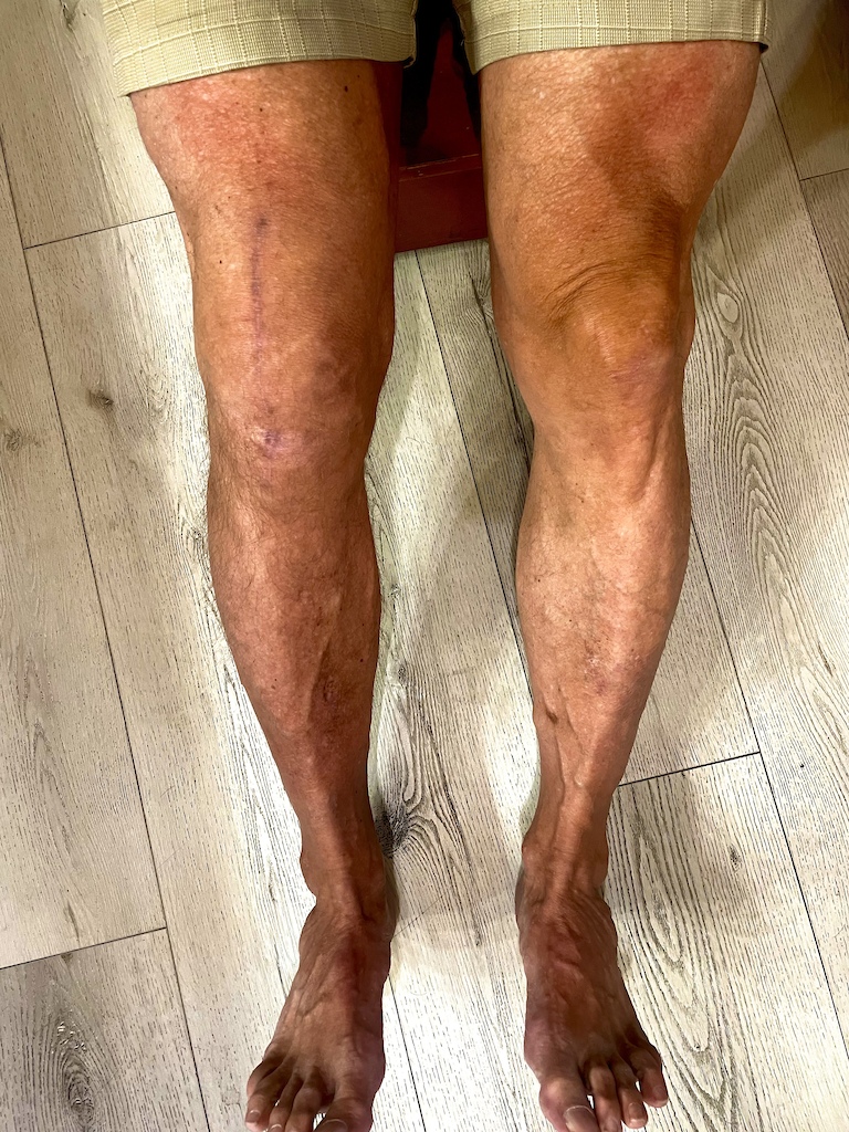 4 months after full knee replacement with a titanium prosthetic. Still cannot ride but getting close to being able to spin the crankset one full rotation. Ahhhh getting old does deflate the bounce back capability so much!
