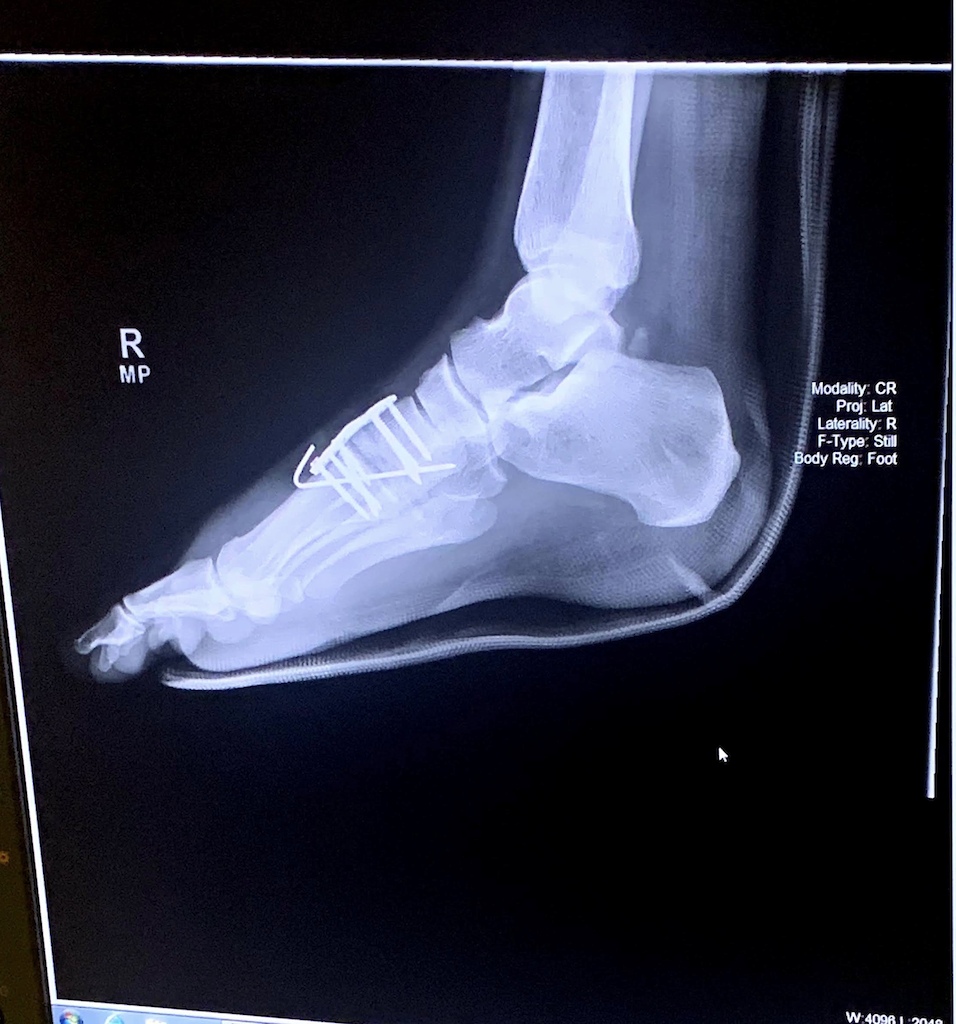 Lisfranc Fracture