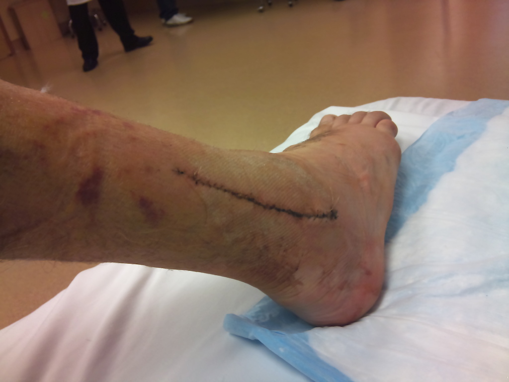 Right side of my ankle after surgery.
