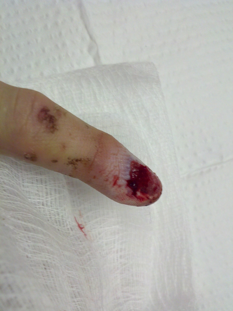 My finger after the doctor removed my nail.