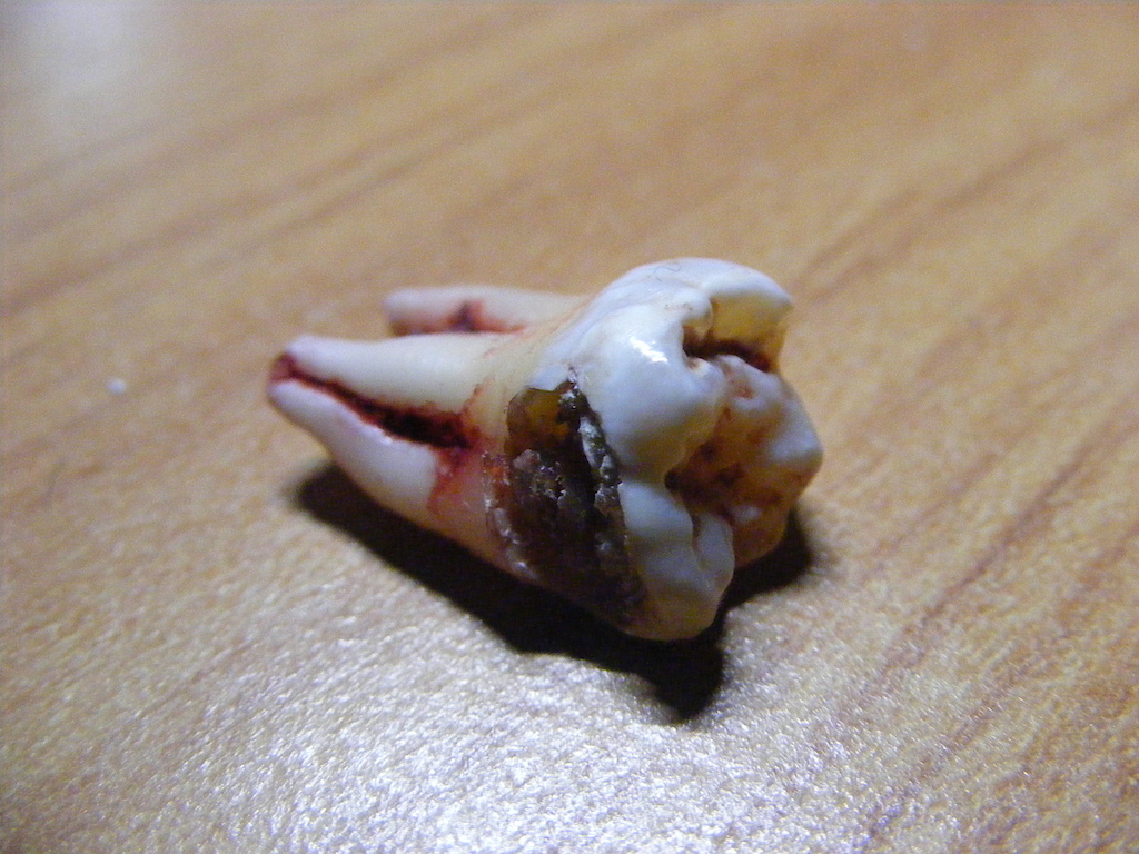 My lovely tooth that had to be pulled out :D