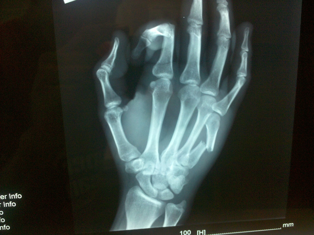 boxxer fracture to the max