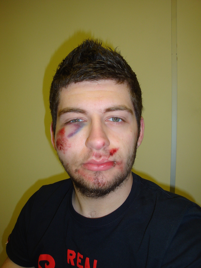7 Hours after my crash, swelling has gone down a bit, but right eye is closing up.

Looking a little elephant-man-ish