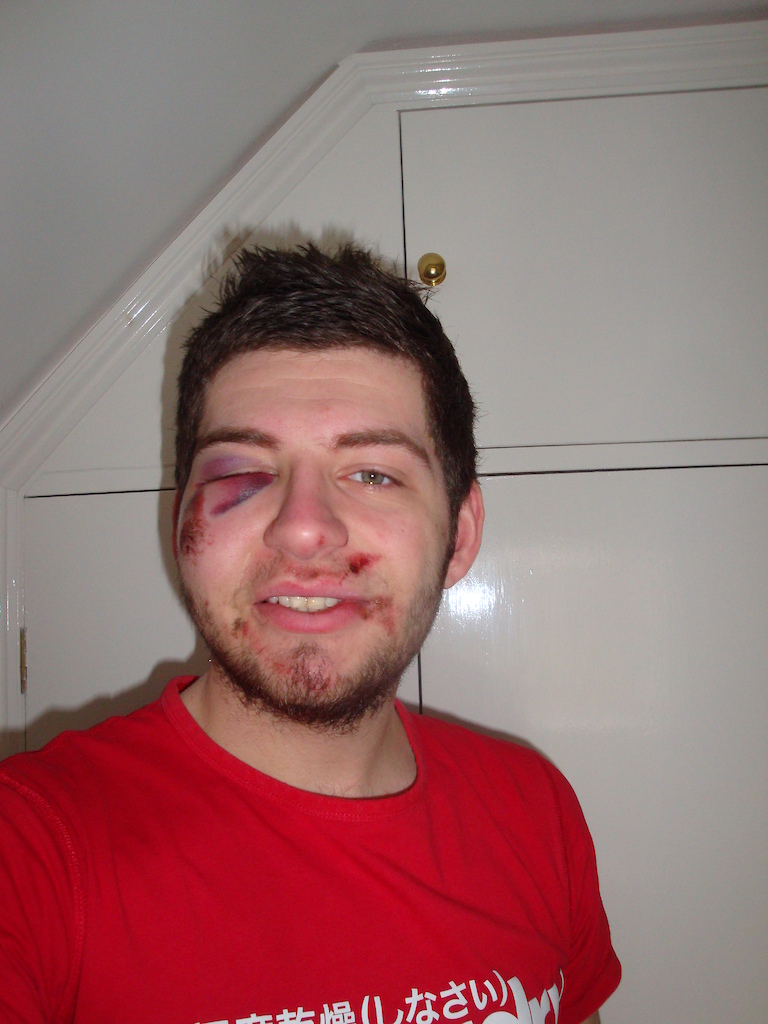1 day gone and face is feeling a bit bigger than normal! cant see a thing out of my right eye