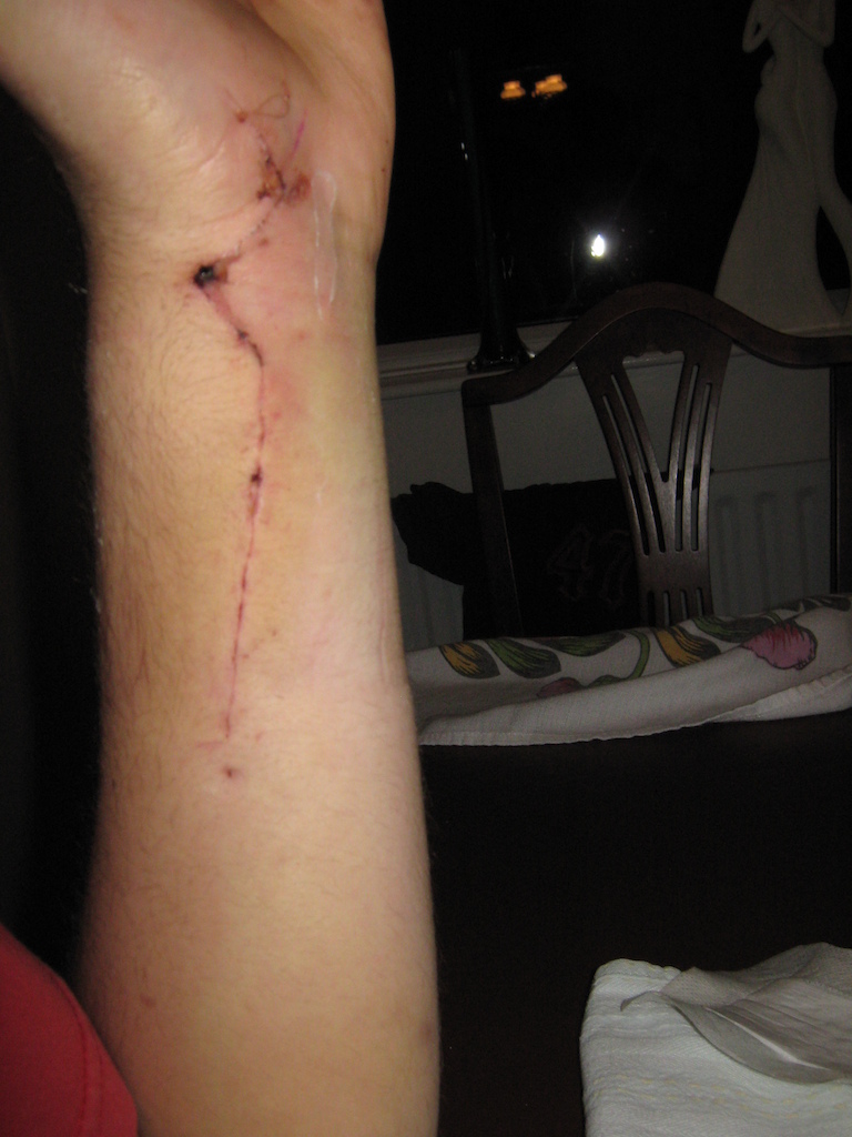 my arm last year :P