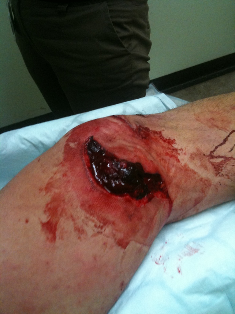 front brake rotor in knee. treliske a+e.