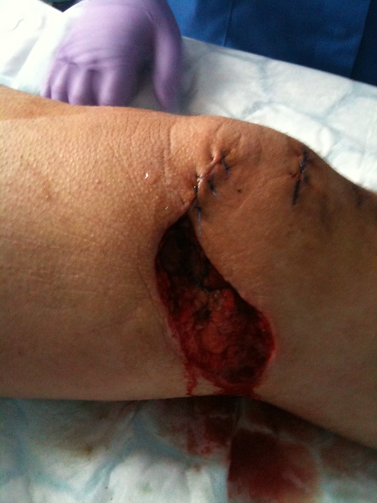 knee after first op