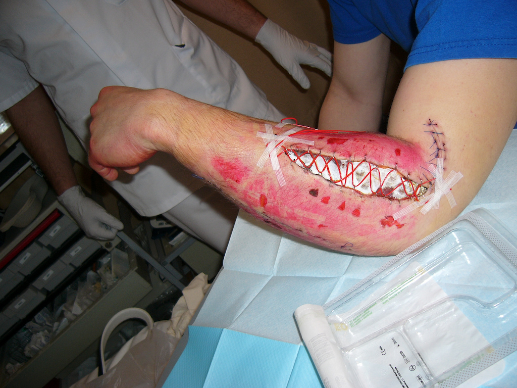 Compartment syndrome