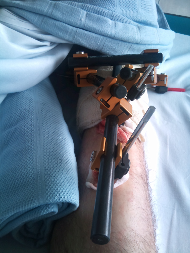 crashed riding to work dislocated and
fractured ankle it 2 places