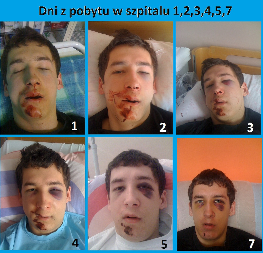 Dni z pobytu w szpitalu...
dzień 1 dzień 2 ...