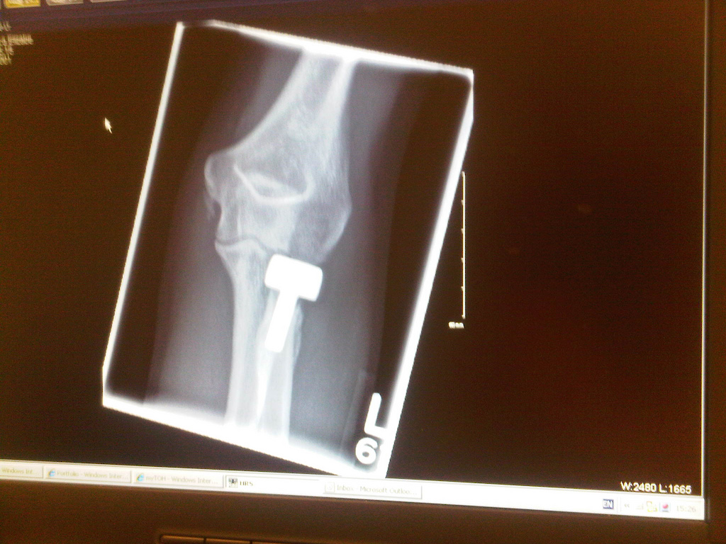 big bolt in my arm. healed up good.
