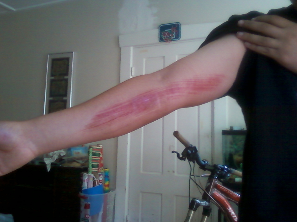 my arm after crashing on a large jump