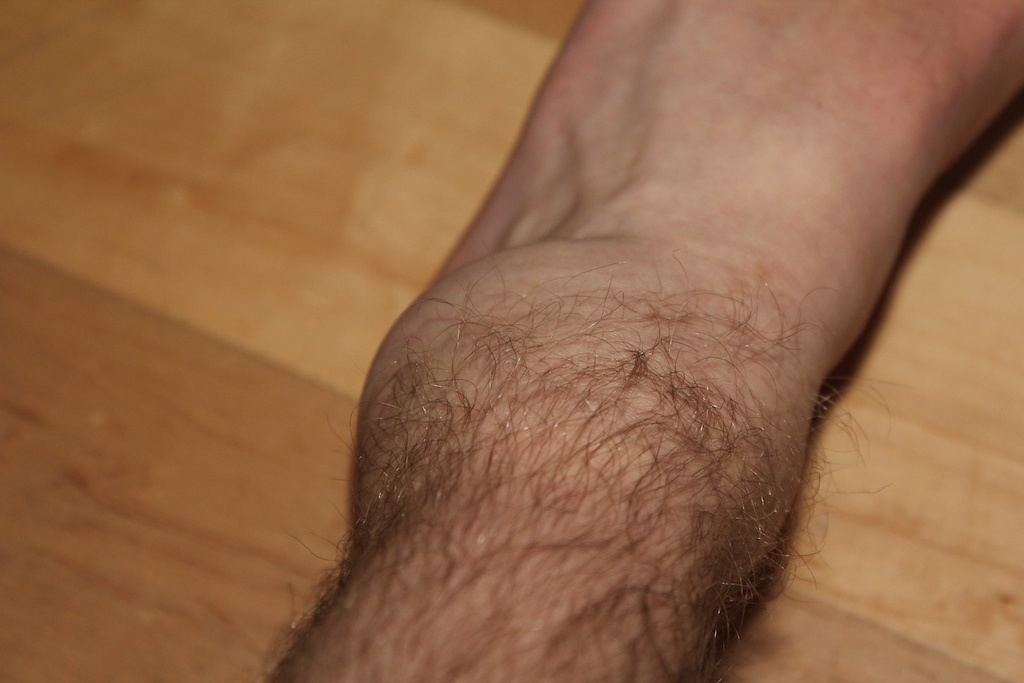 Broken ankle.