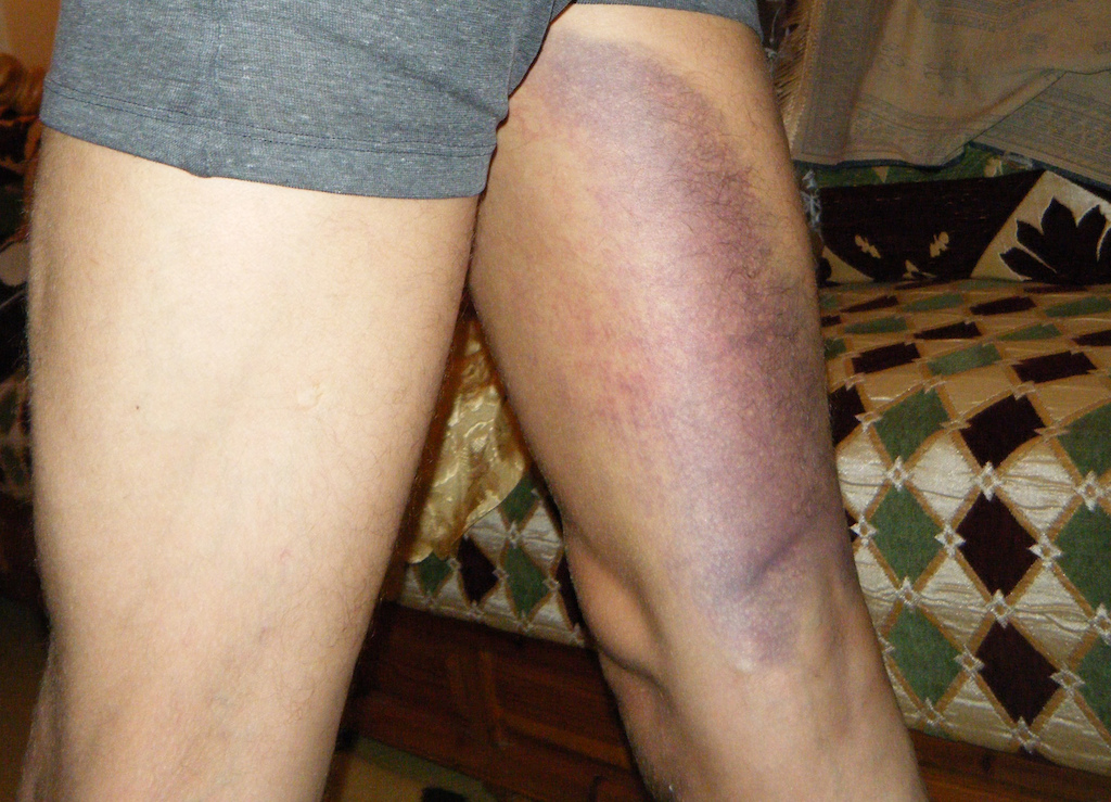 terrible crush my thigh landed on my shirters, caused an internal injurie in the muscle.