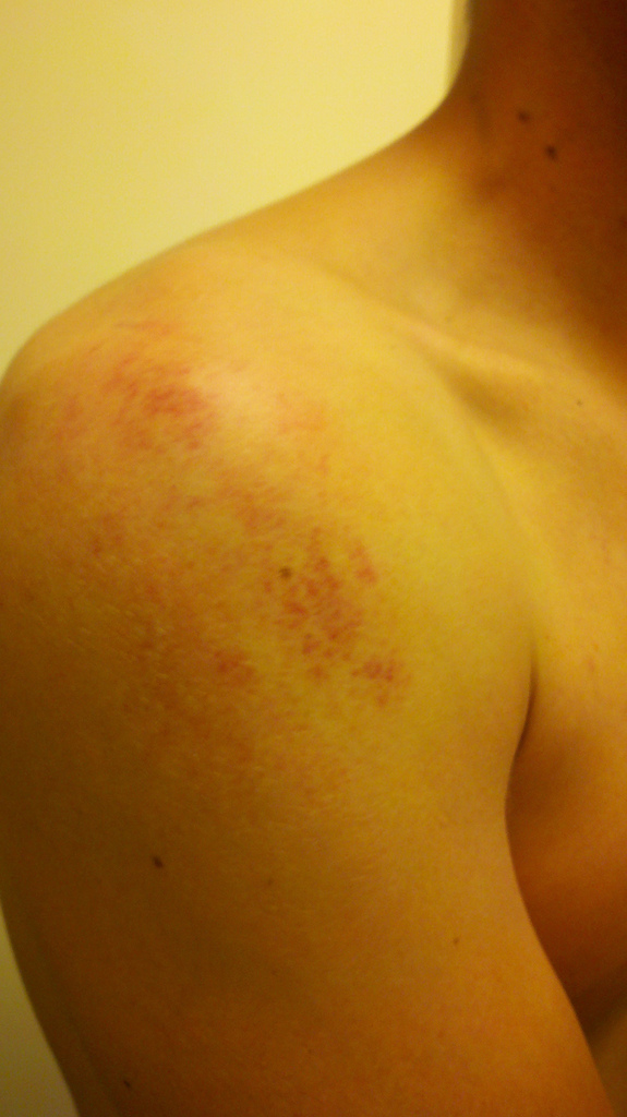 this is what happens when you dislocate then relocate your shoulder.