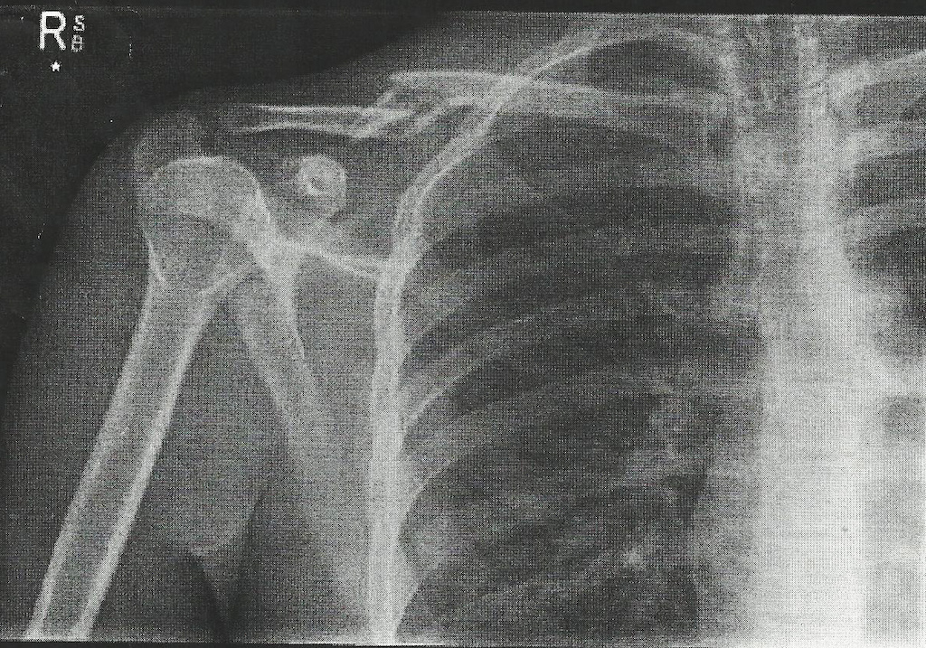 Broken collar bone xray