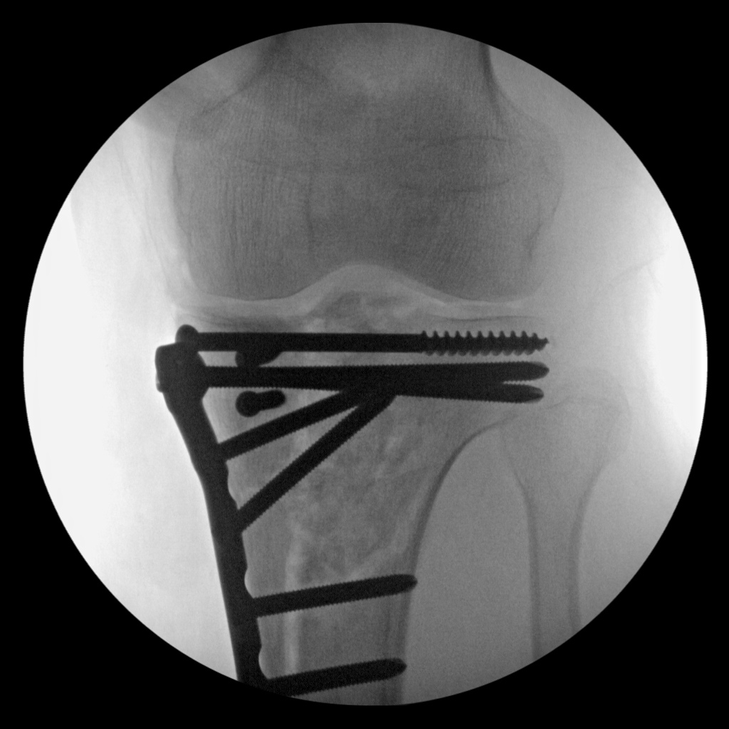 lower knee section