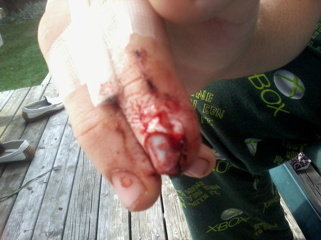 broken index finger, sprained middle finger...ouch