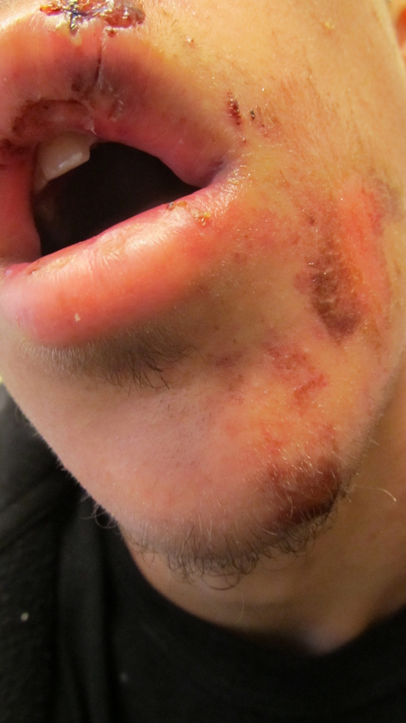 Hitting a ledge 3-4 feet high, going about 25-30km, back tire casted, i went over handle bars, and landed on my face.