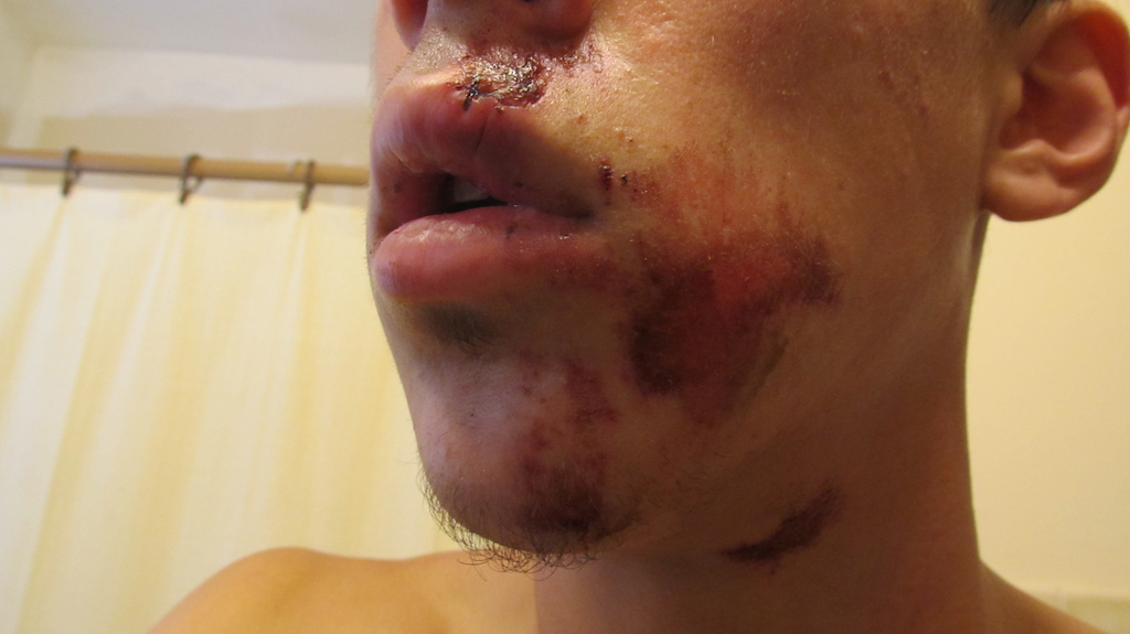Hitting a ledge 3-4 feet high, going about 25-30km, back tire casted, i went over handle bars, and landed on my face.