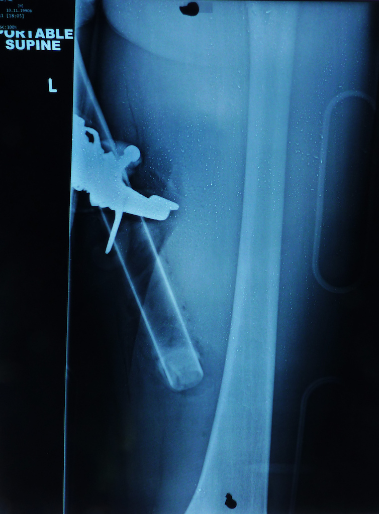 X-ray showing the Handlebar in my thigh