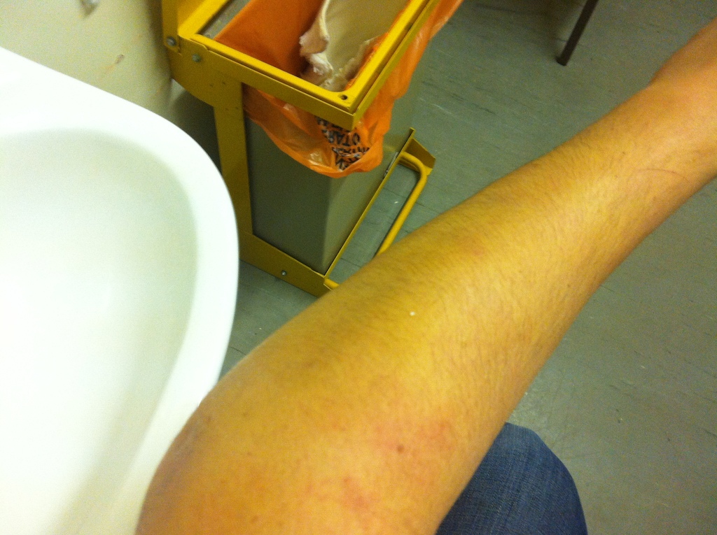 Arm swelling, looks like a leg! ha