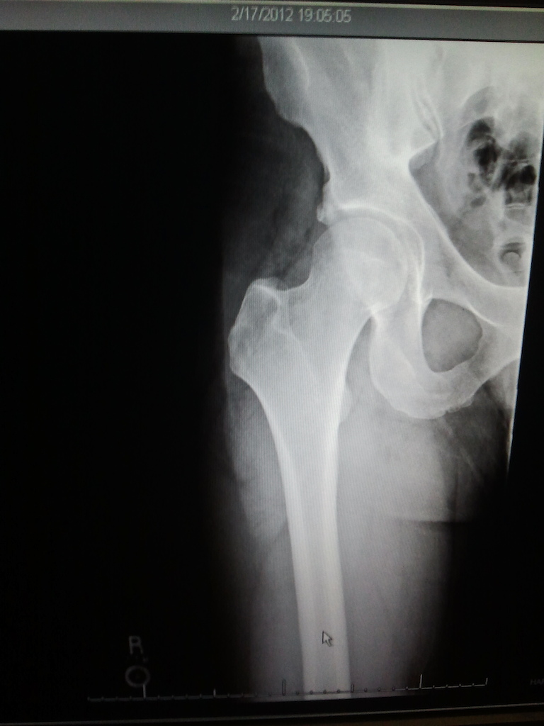 major contusion,hematoma,big bruse. thought i broke my femur again.finally a x-ray with a good ending!!!!!!