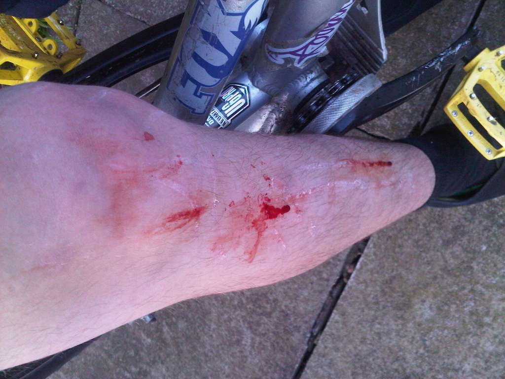 foot slipped of pedals