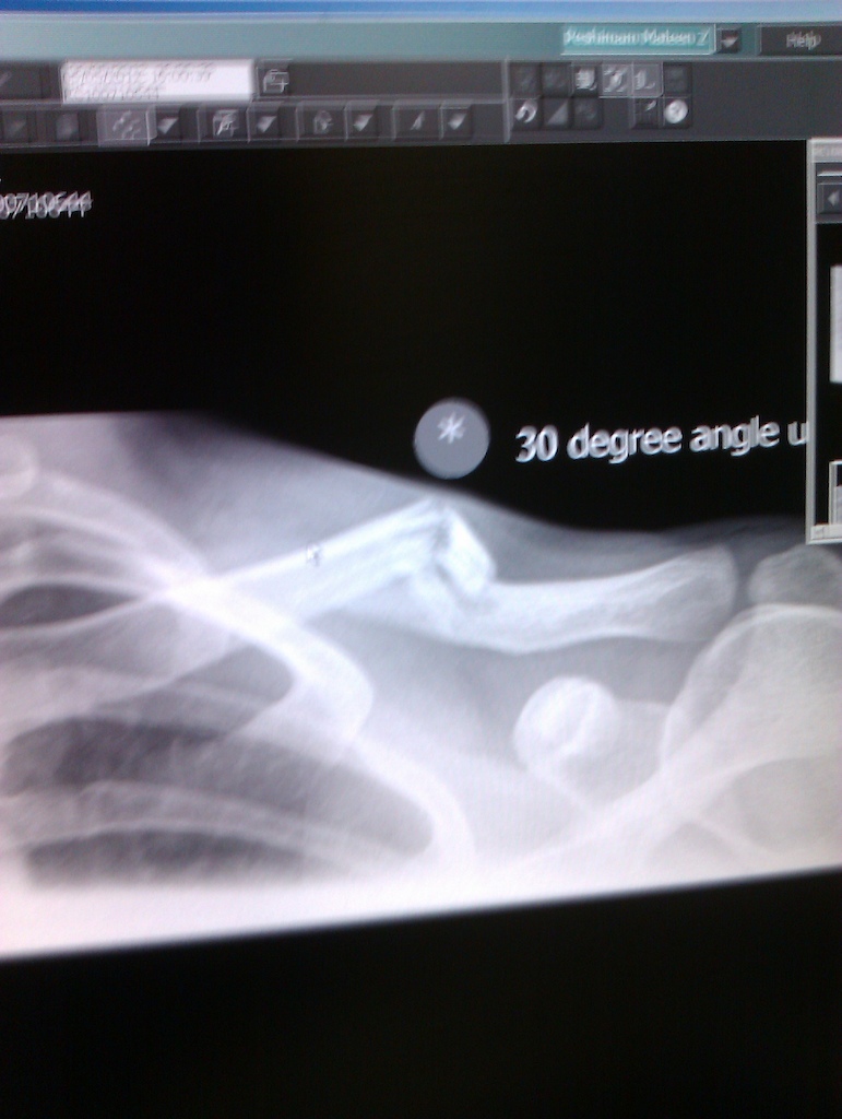 nice broken collor bone SICK!!