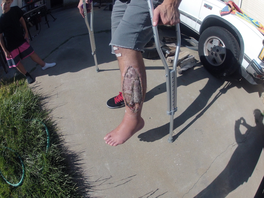 My leg with the skin graft.  Pretty gross.