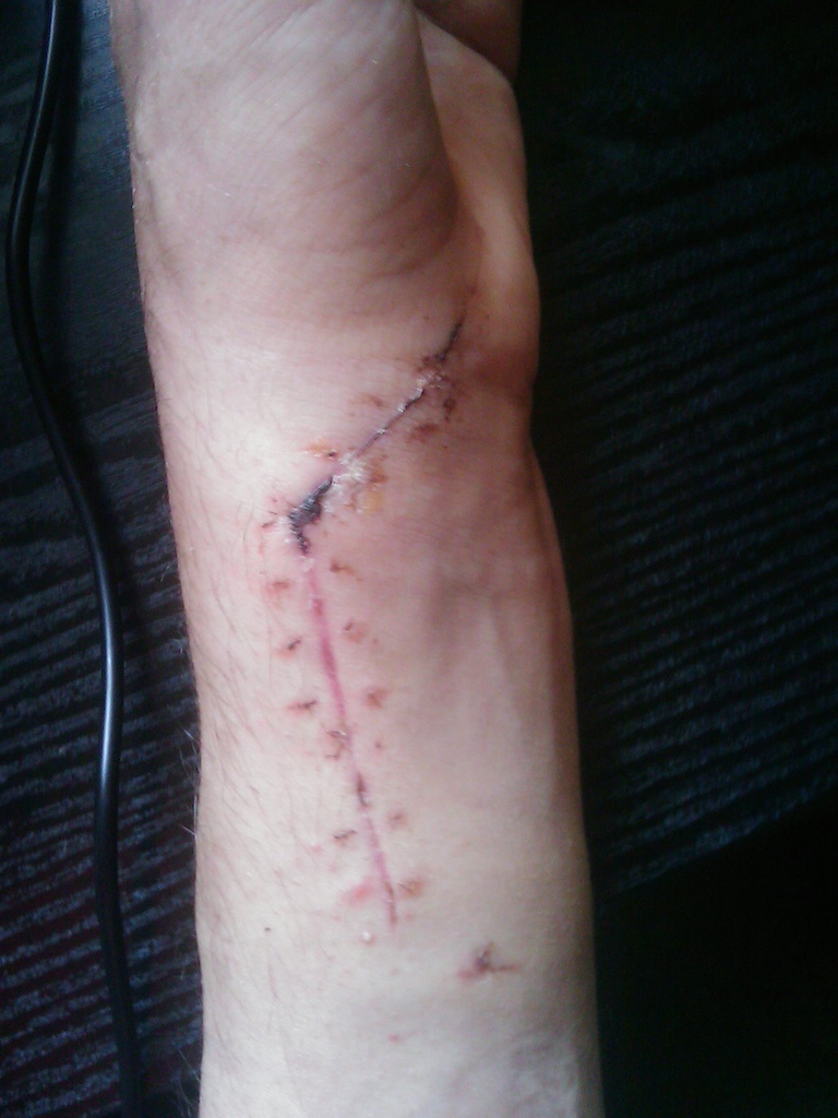 12 stiches and titanium plate inside