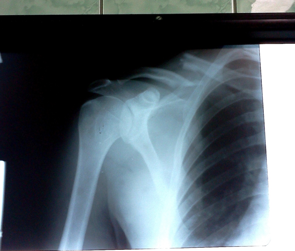 And all the plans for this summer gone... broken collarbone :/