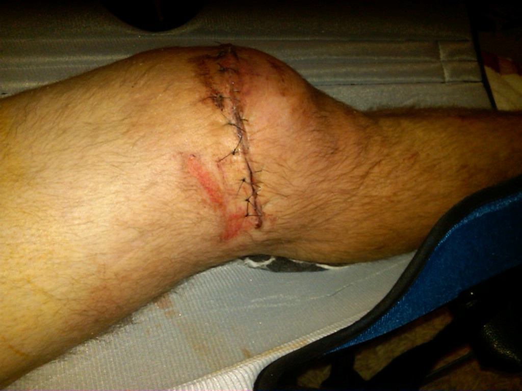 My stitches from the lateral side