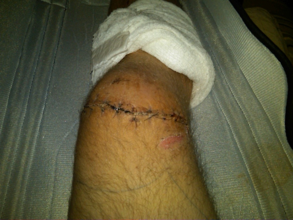 My right knee, 9 days after surgery/accident