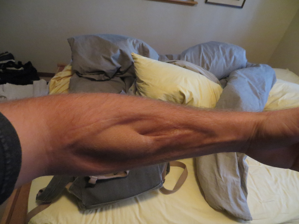 10 years ago i broke my arm on a trail. Compound fracture both bones sticking out of my arm about an inch or two. The pic here is a skin graph. The took skin off my thigh and attached it to my arm.