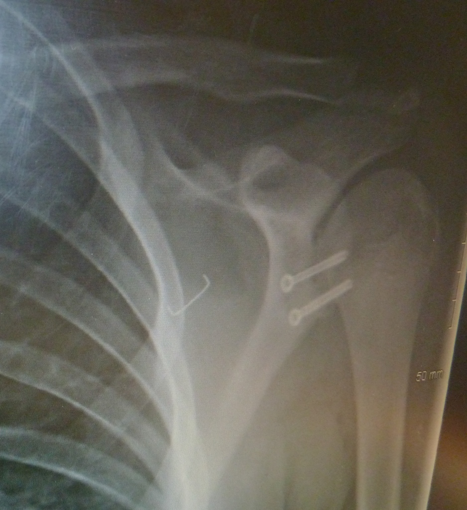 X-ray of the 2 titanium screws in my shoulder and somehow a staple got in there as well...