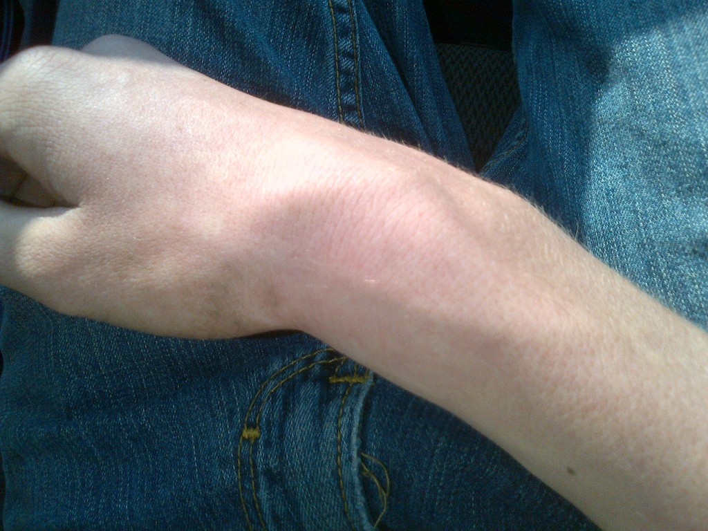 My broken wrist. Its all good now though