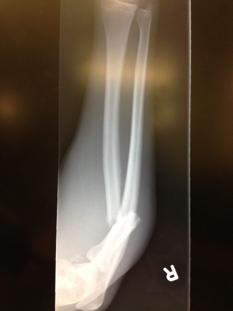 My Dislocated elbow/Broken Radius/Broken Ulna.
