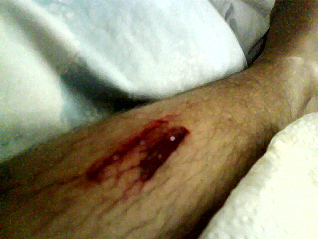 A old crash I did in 2008, got the pedal right in to the leg. Sorry for the bad quality.