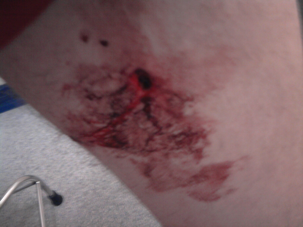 Brake lever in my thigh :/