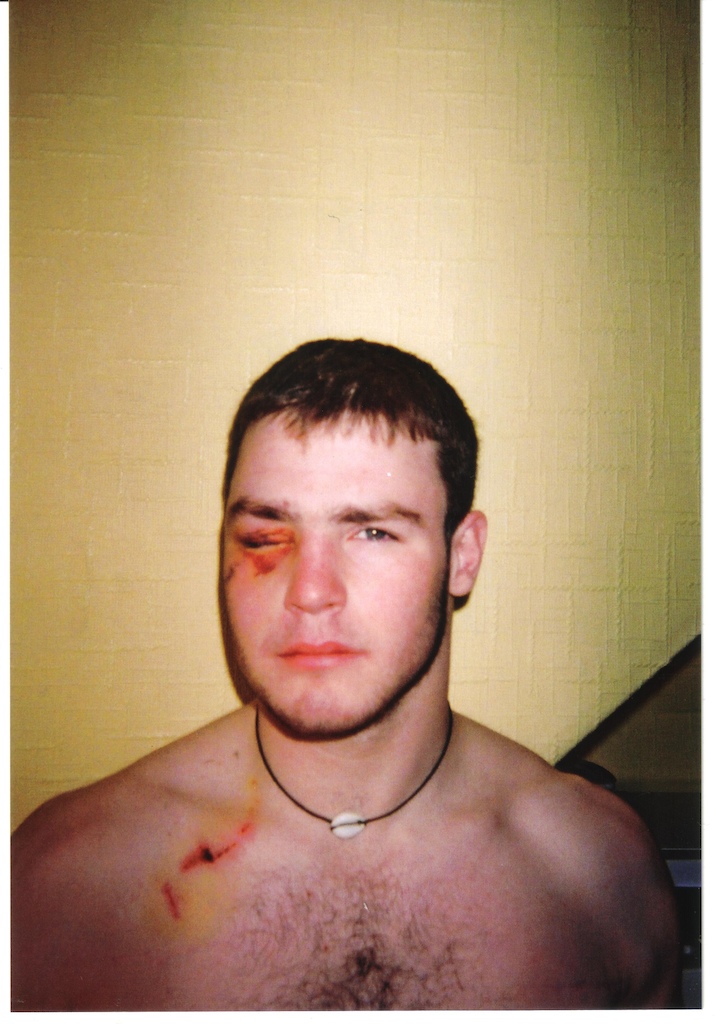 me 15years ago after my first dh race where i forgot to use my hand brake and opted for the favce brake instead. i am now the proud owner of a metal plate in my face that holds my eyeball in the correct position