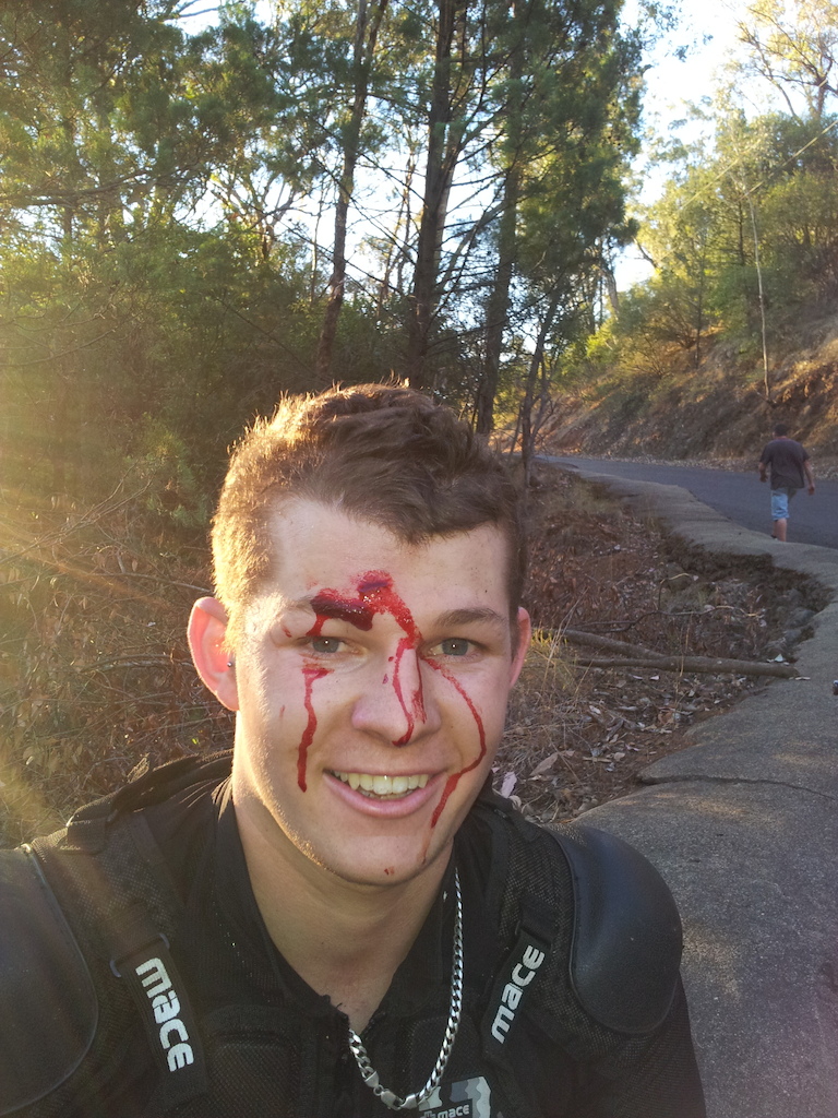 My mate had three crashes on his run, this is the result of his third lol a nice face plant into a big rock.