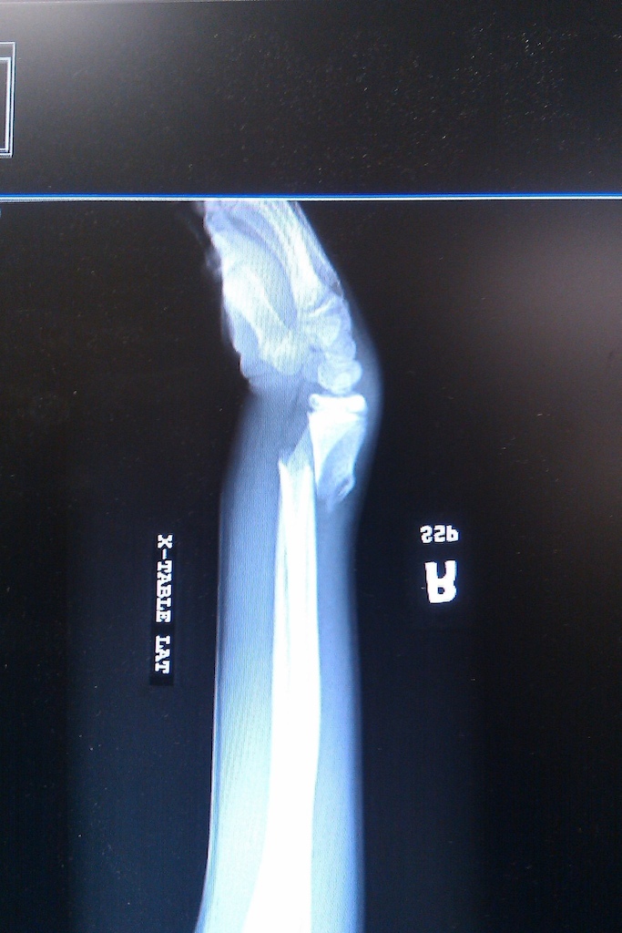 my 1st broken arm