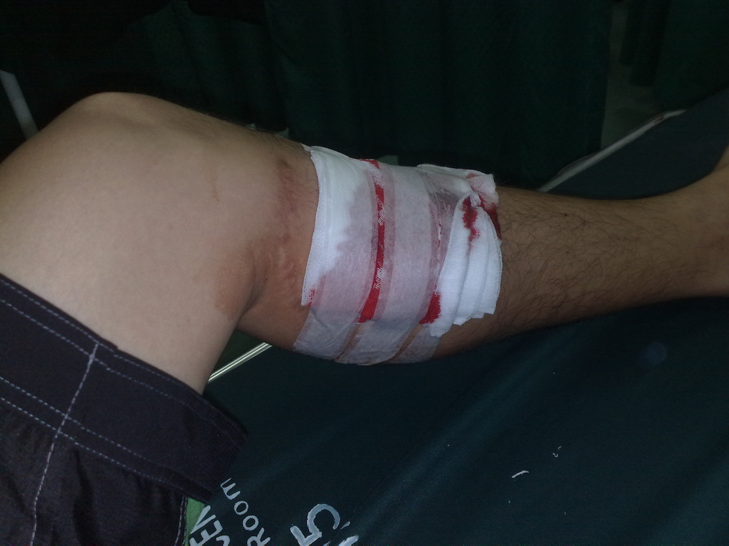 got my self into moto accident. stitches just below the old one.