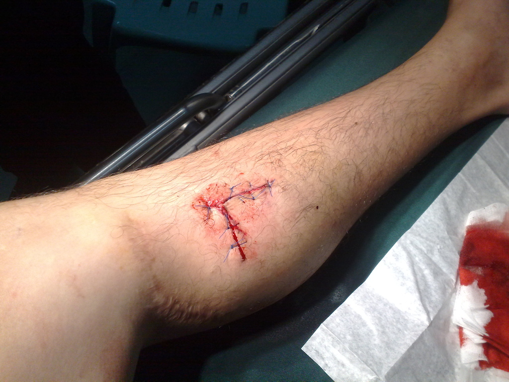 got my self into moto accident. stitches just below the old one.