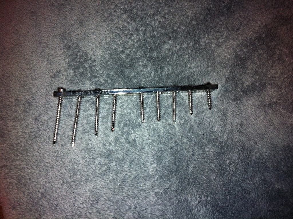 plate and screws that came out of my leg