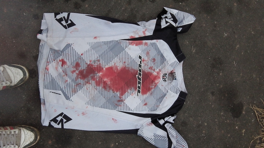 The Jersey. A loose rock on a steep technical section completely did ben over resulting in a gnarly faceplant. Didnt have time to take his hands off the bars so he ended up munching rock leaving him one tooth down. damn